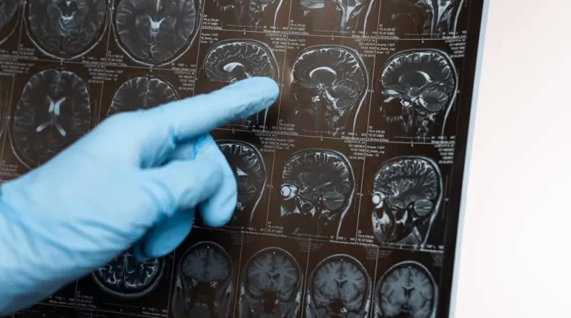 La IA y la Lucha contra el Alzheimer: Identificando Genes y Acelerando el Desarrollo de Medicamentos